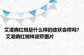 艾滋病红斑是什么样的症状会痒吗? 艾滋病红斑样皮疹图片 