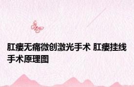 肛瘘无痛微创激光手术 肛瘘挂线手术原理图 